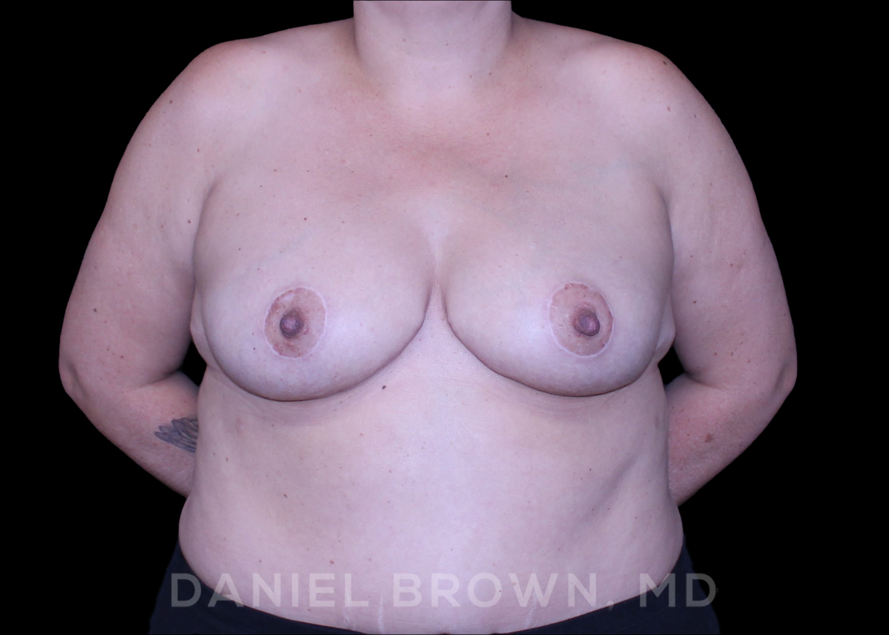 Bellesoma Breast Lift Patient Photo - Case 164 - after view-0