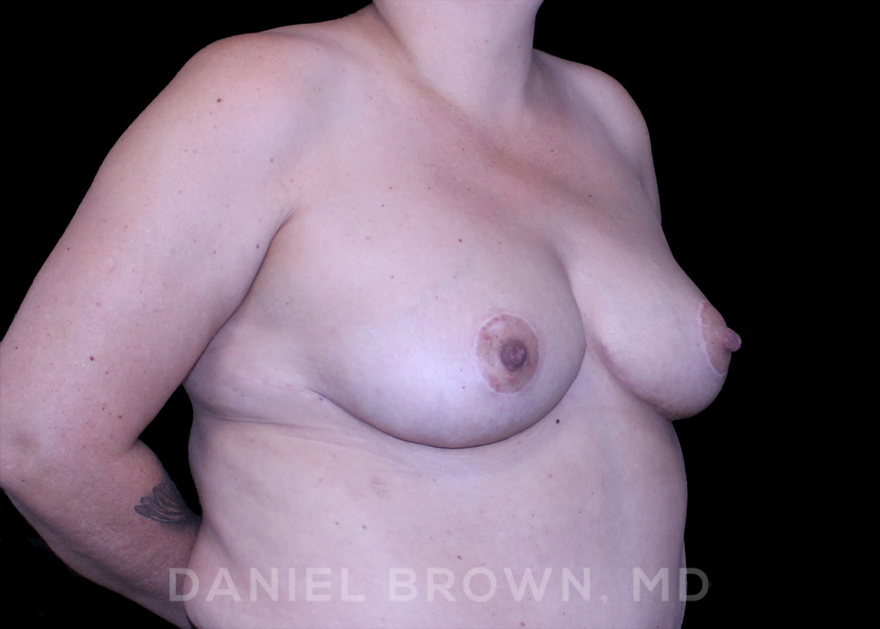 Bellesoma Breast Lift Patient Photo - Case 164 - after view