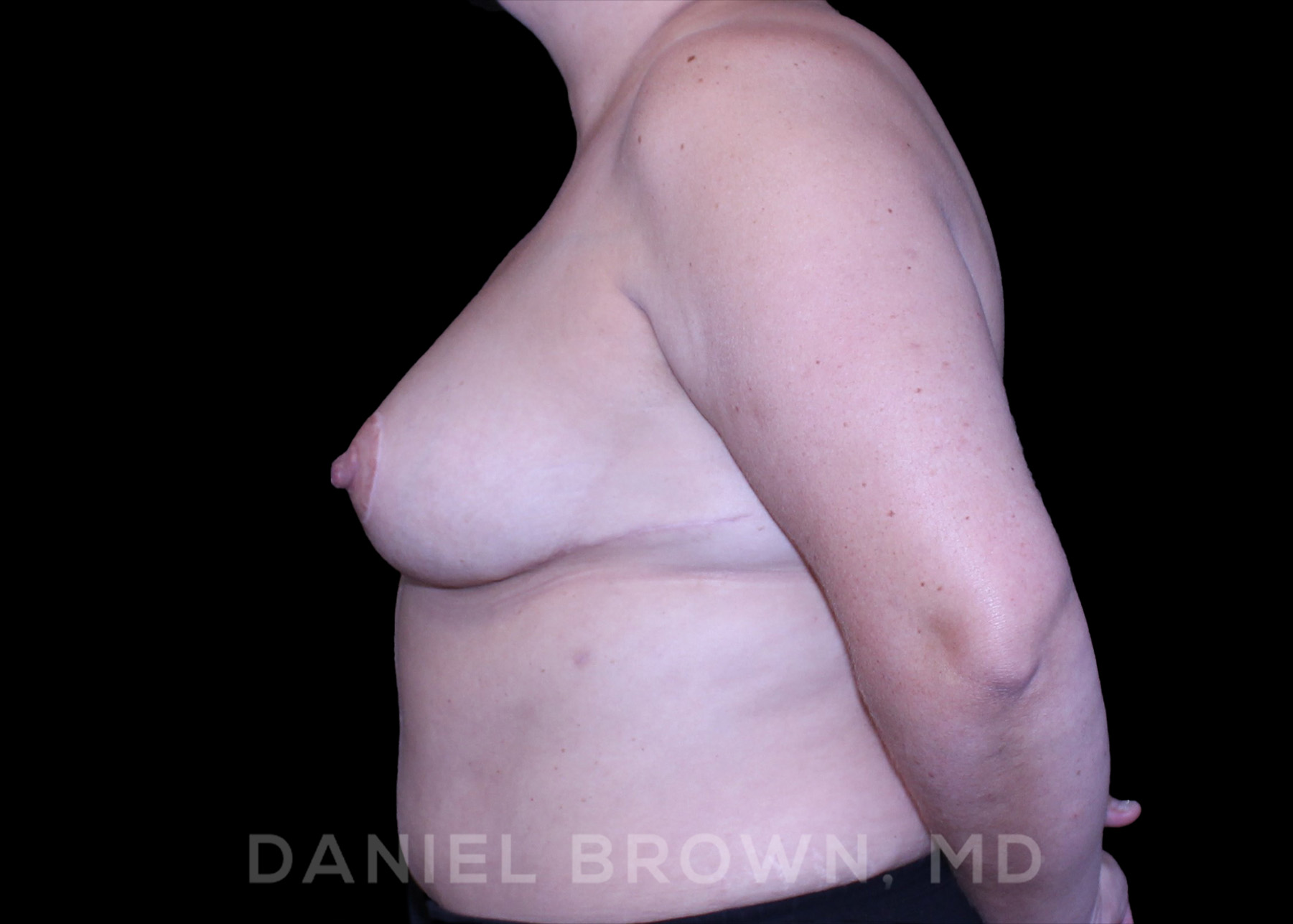Bellesoma Breast Lift Patient Photo - Case 164 - after view-3