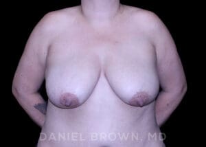 Bellesoma Breast Lift - Case 164 - Before