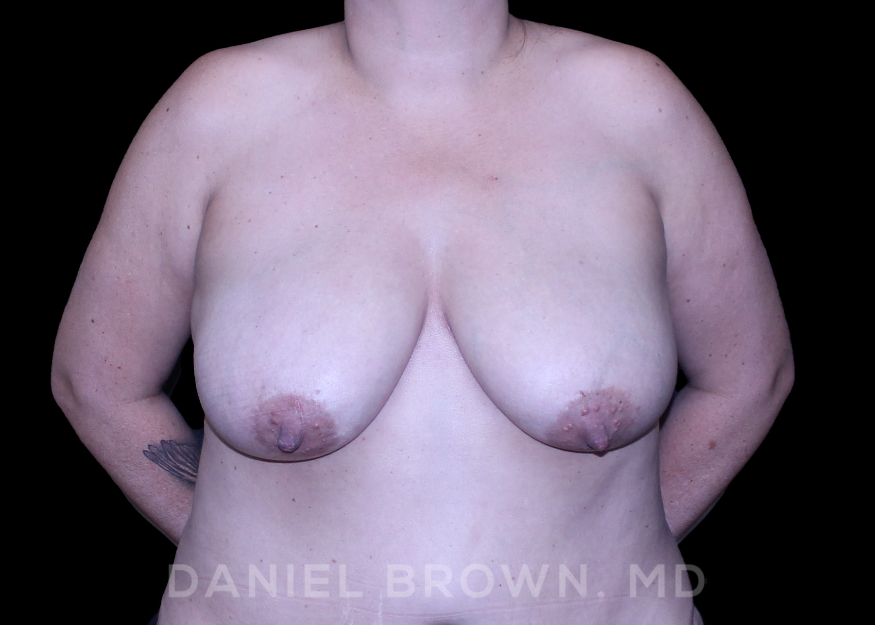 Bellesoma Breast Lift Patient Photo - Case 164 - before view-