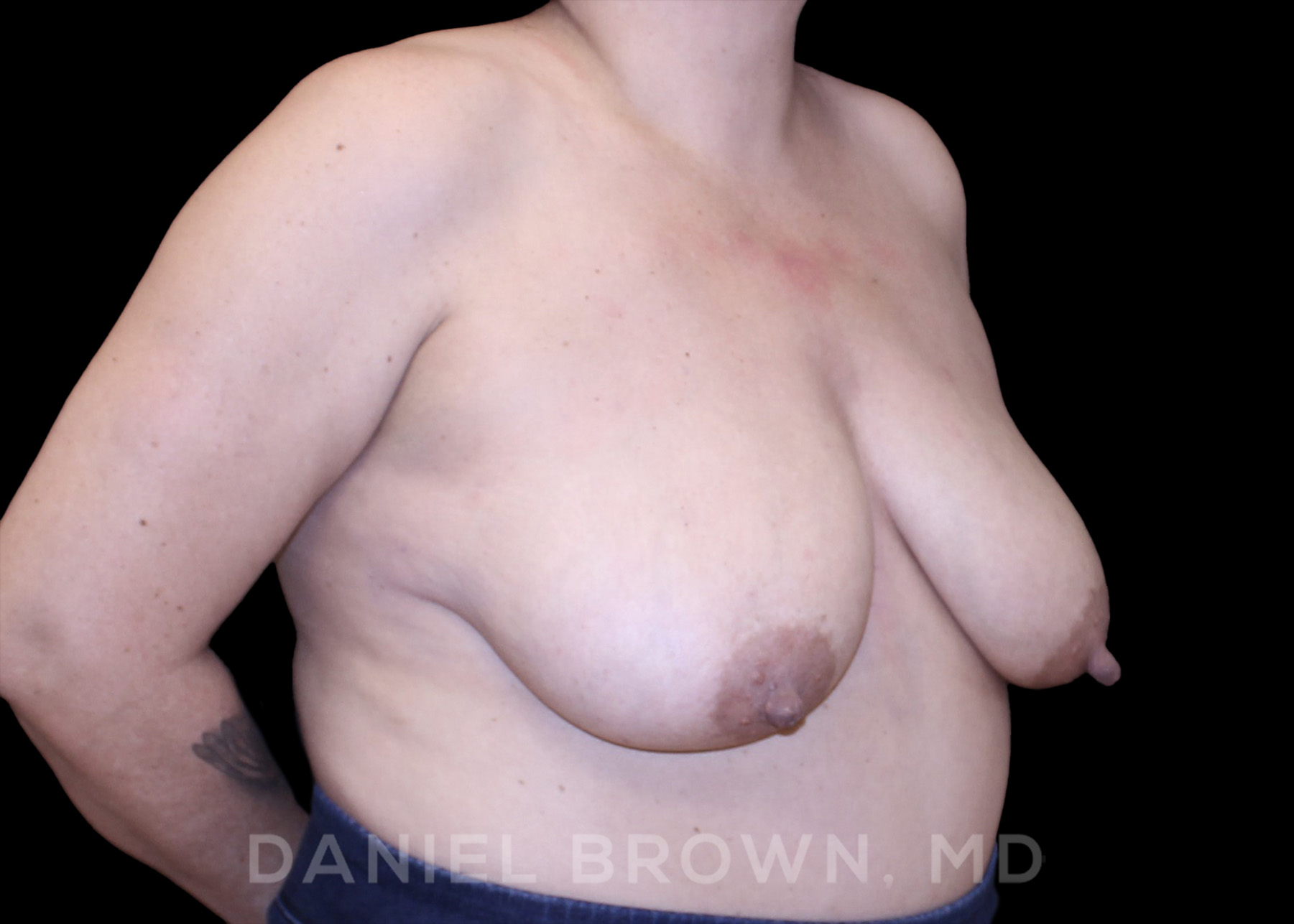 Bellesoma Breast Lift Patient Photo - Case 164 - before view-2