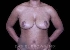 Bellesoma Breast Lift - Case 210 - After