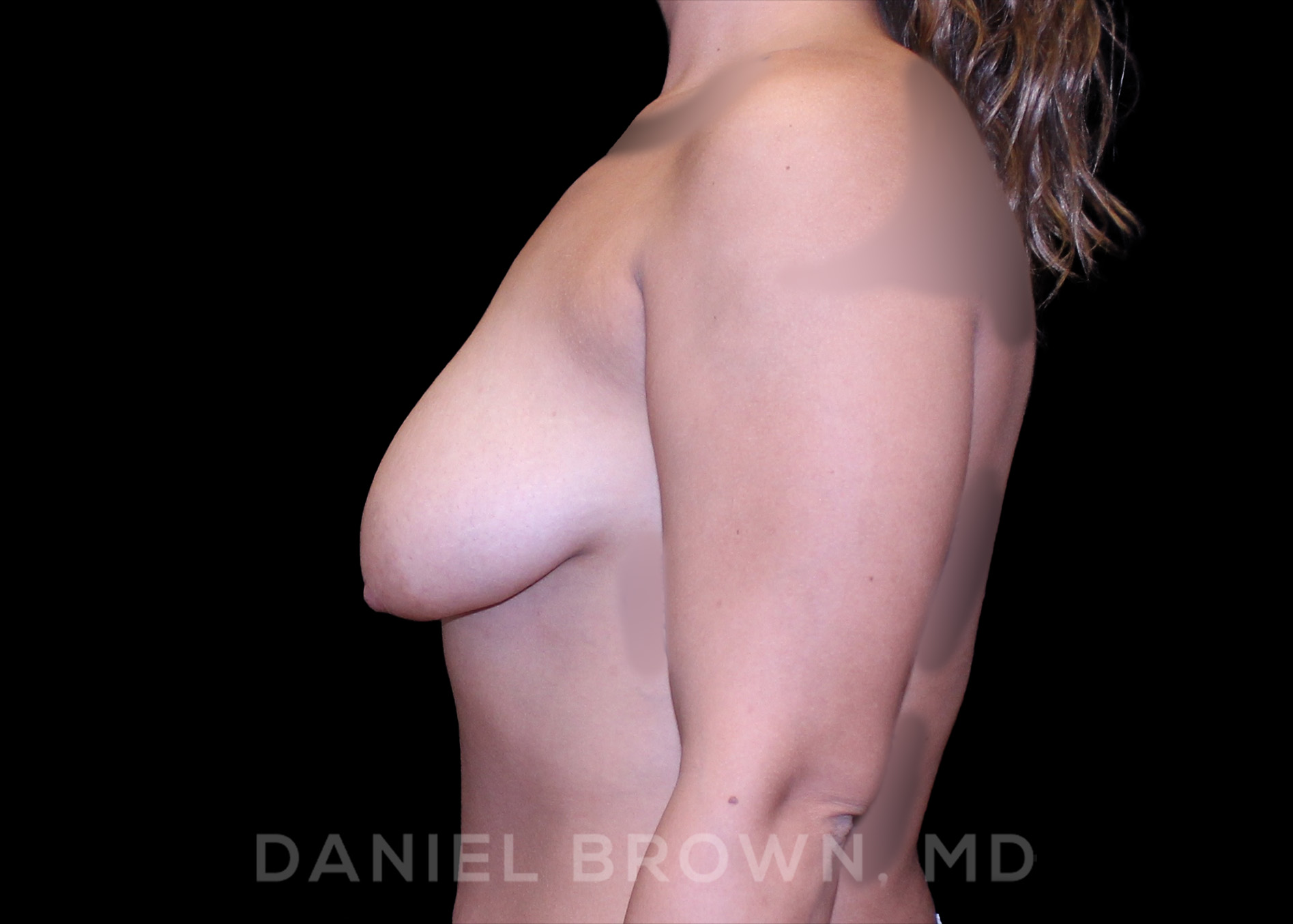 Bellesoma Breast Lift Patient Photo - Case 228 - before view-3