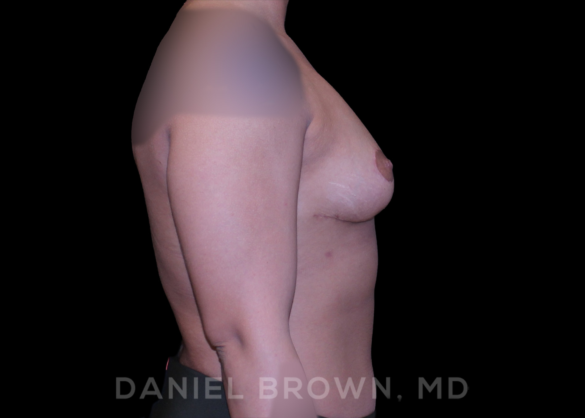 Bellesoma Breast Lift Patient Photo - Case 228 - after view