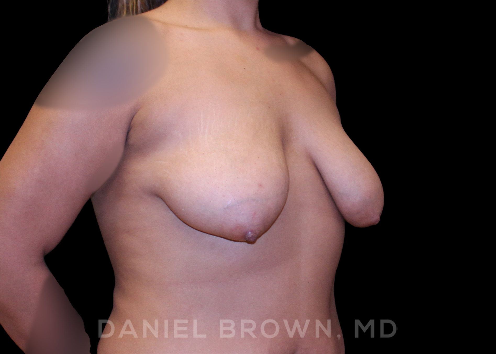 Bellesoma Breast Lift Patient Photo - Case 228 - before view-2