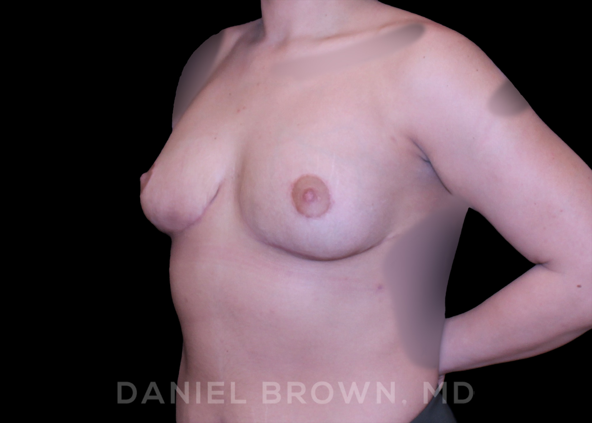Bellesoma Breast Lift Patient Photo - Case 228 - after view