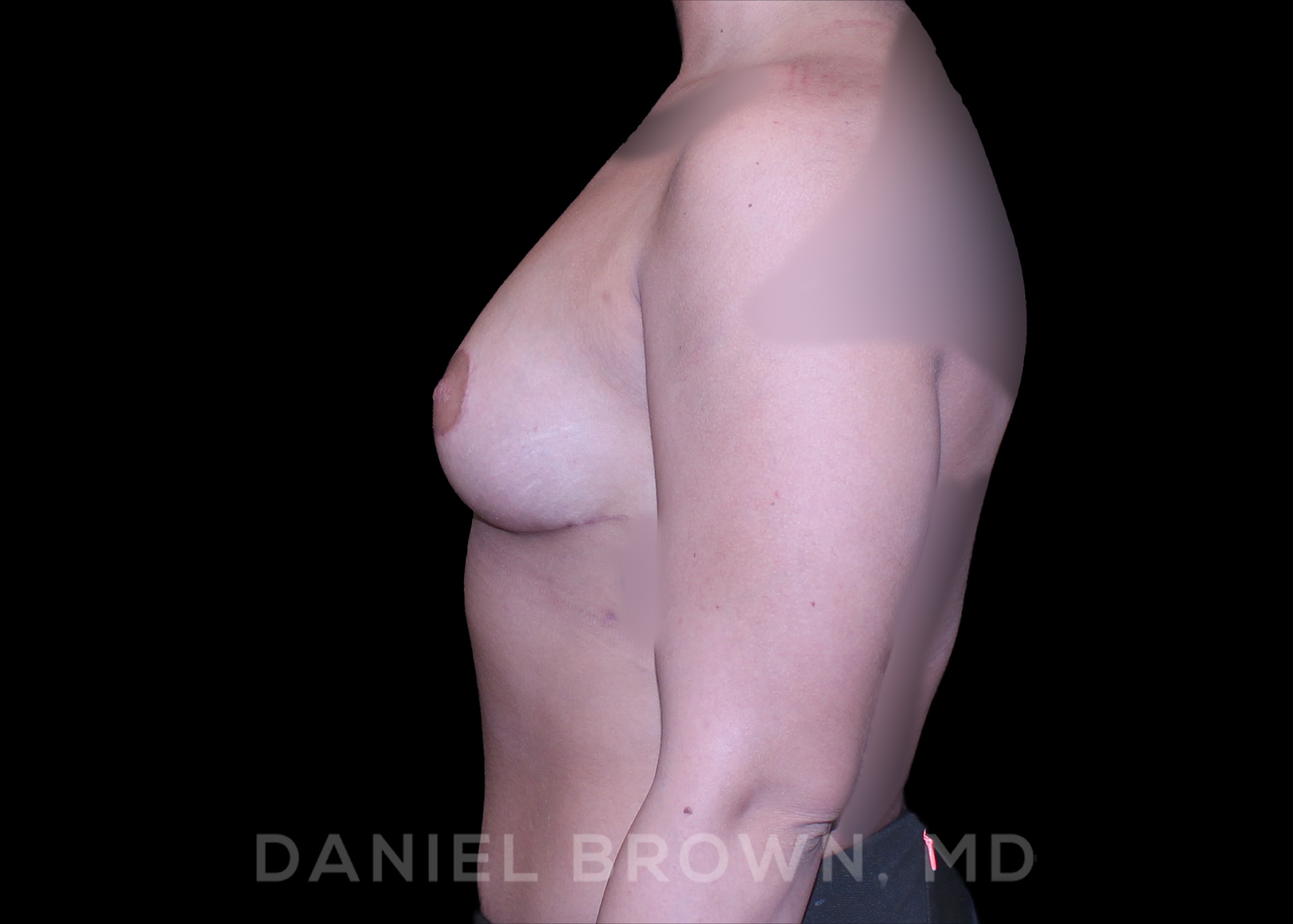 Bellesoma Breast Lift Patient Photo - Case 228 - after view-3