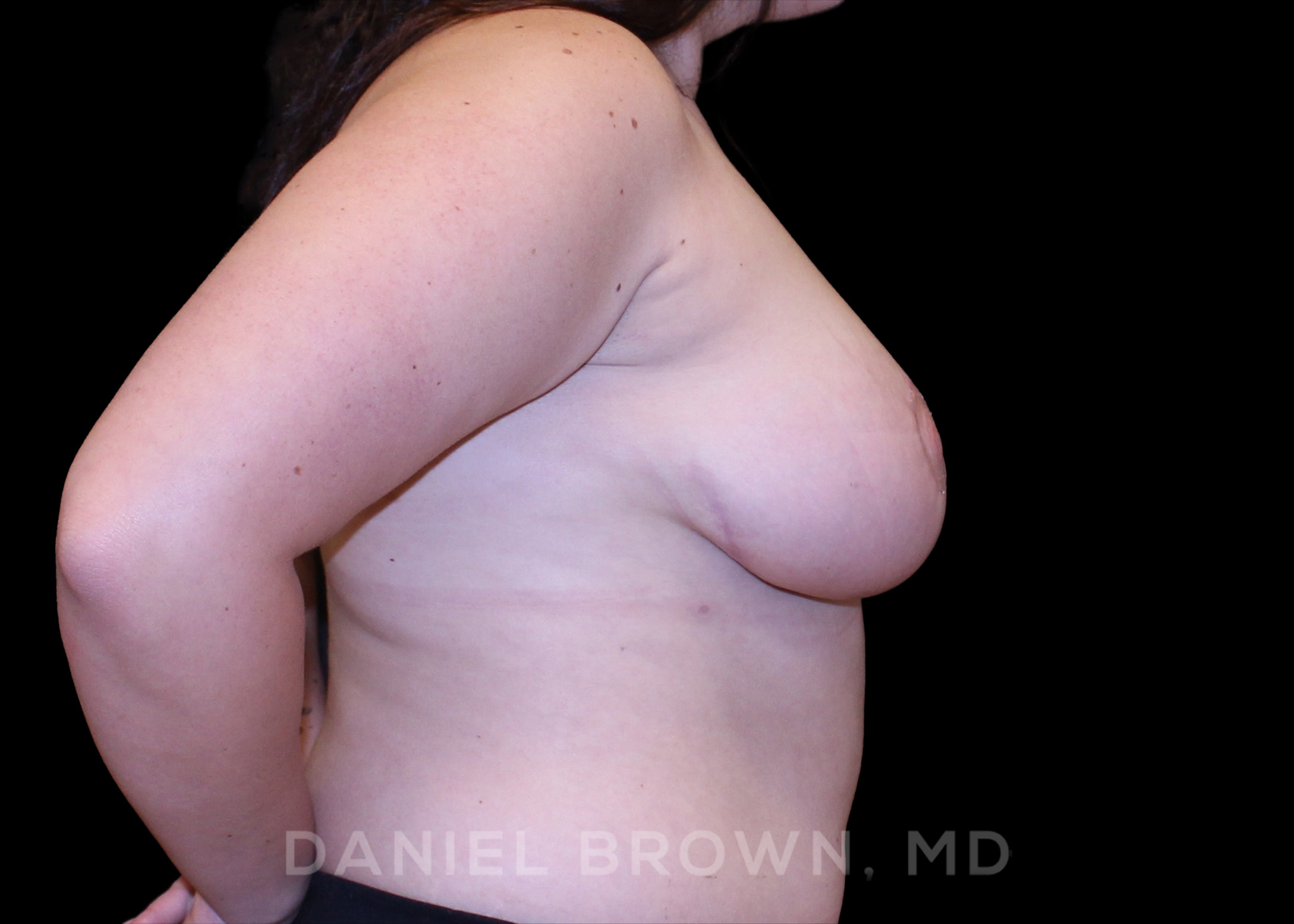 Bellesoma Breast Lift Patient Photo - Case 239 - after view
