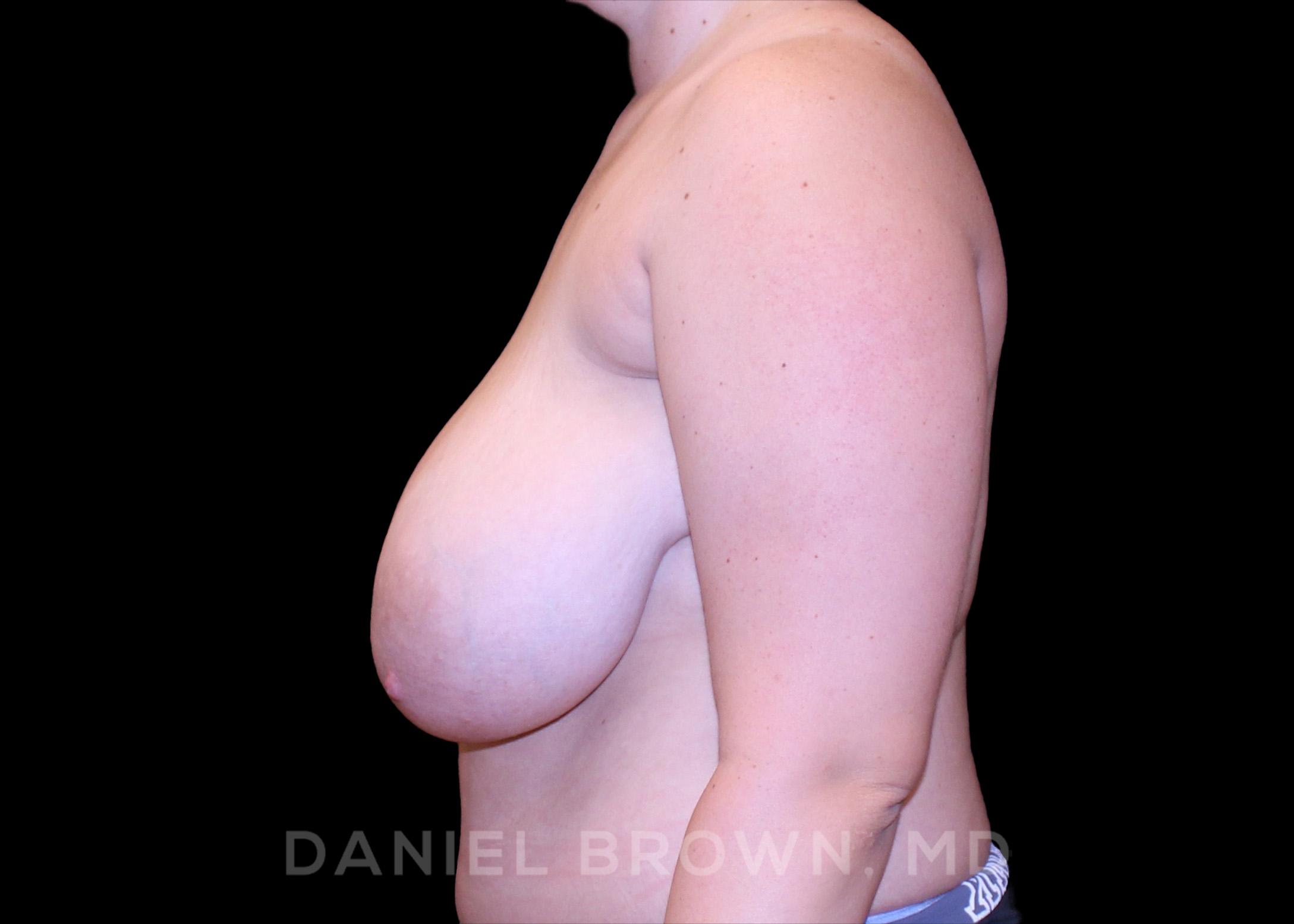 Bellesoma Breast Lift Patient Photo - Case 239 - before view-