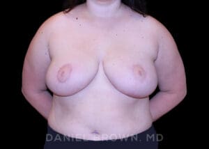 Bellesoma Breast Lift - Case 239 - After