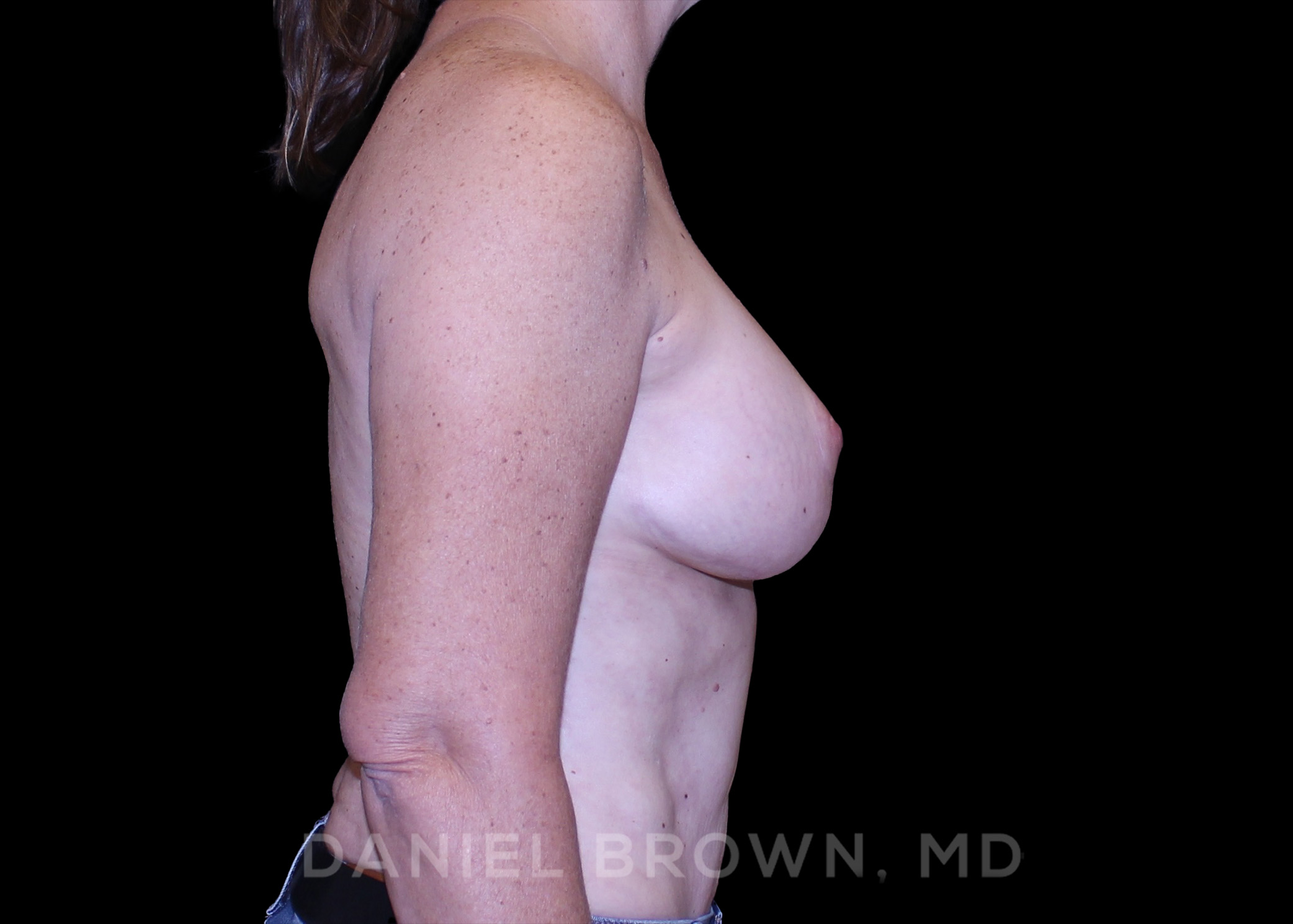 Bellesoma Breast Lift Patient Photo - Case 246 - after view-4