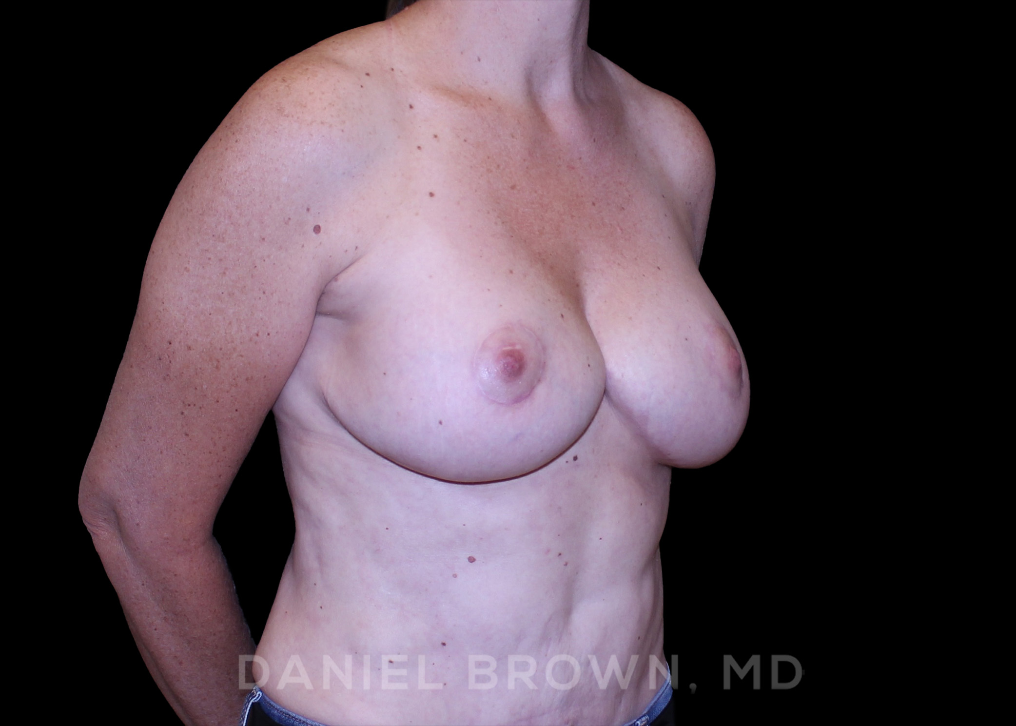 Bellesoma Breast Lift Patient Photo - Case 246 - after view-2