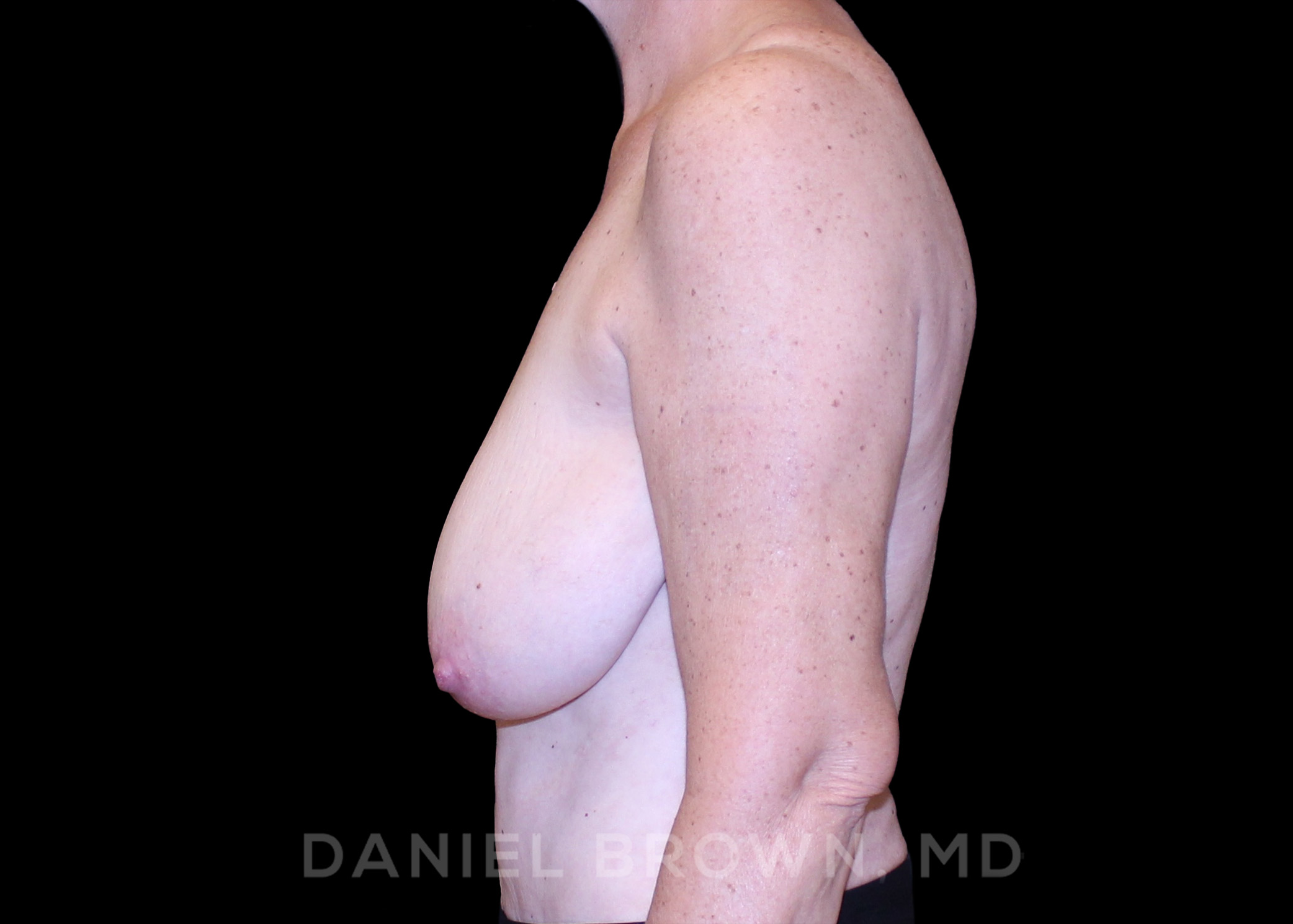 Bellesoma Breast Lift Patient Photo - Case 246 - before view-