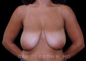 Bellesoma Breast Lift - Case 257 - Before