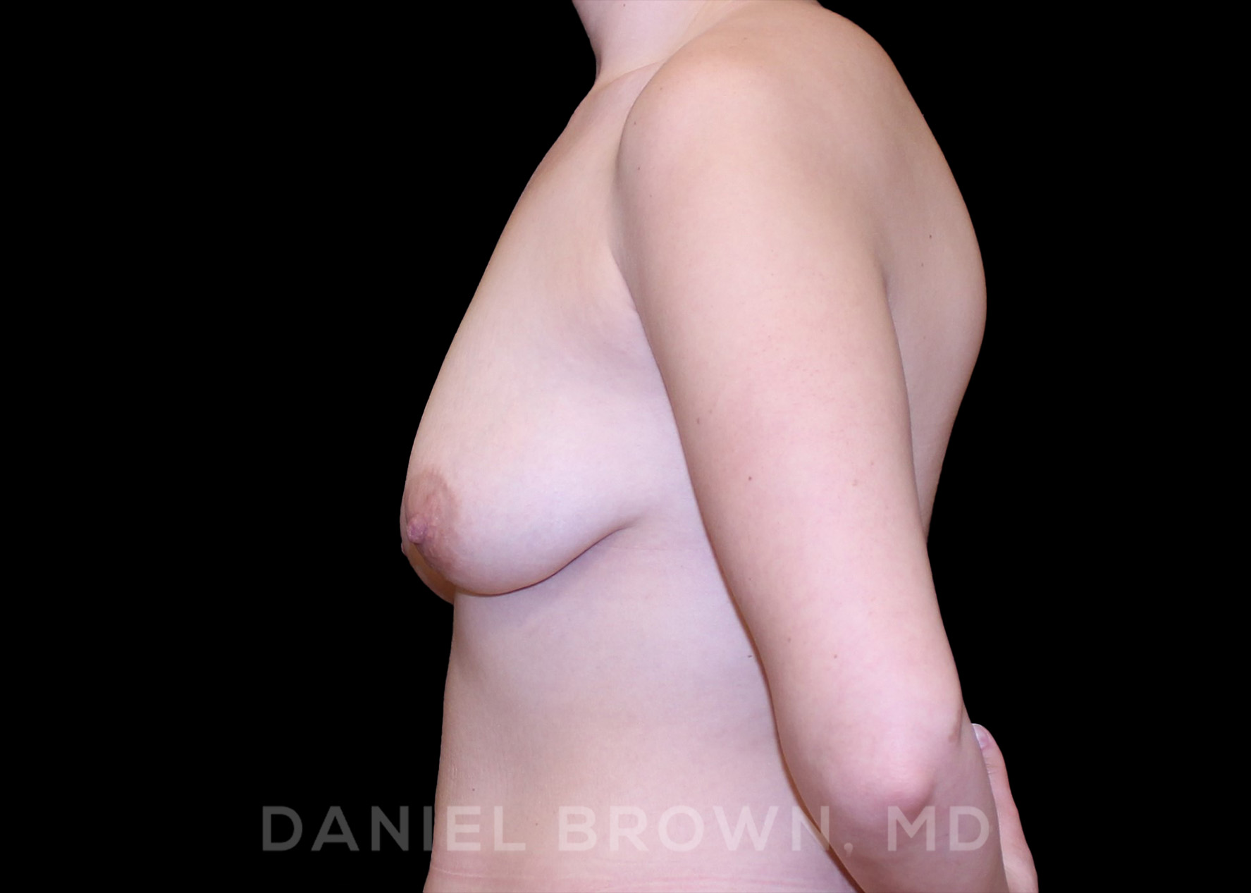 Bellesoma Breast Lift Patient Photo - Case 268 - before view-