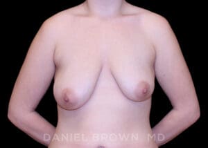Bellesoma Breast Lift - Case 268 - Before