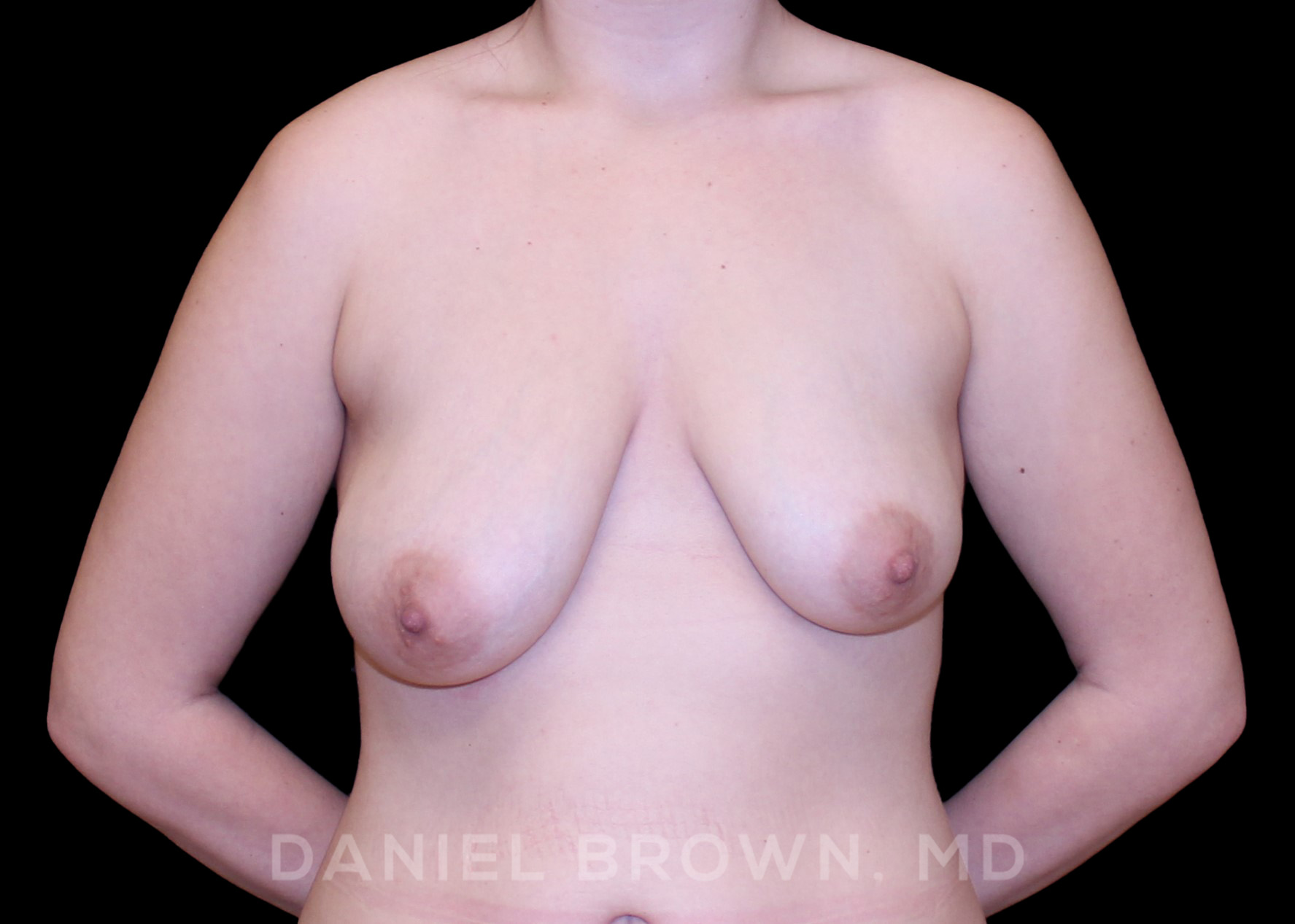 Bellesoma Breast Lift Patient Photo - Case 268 - before view-0