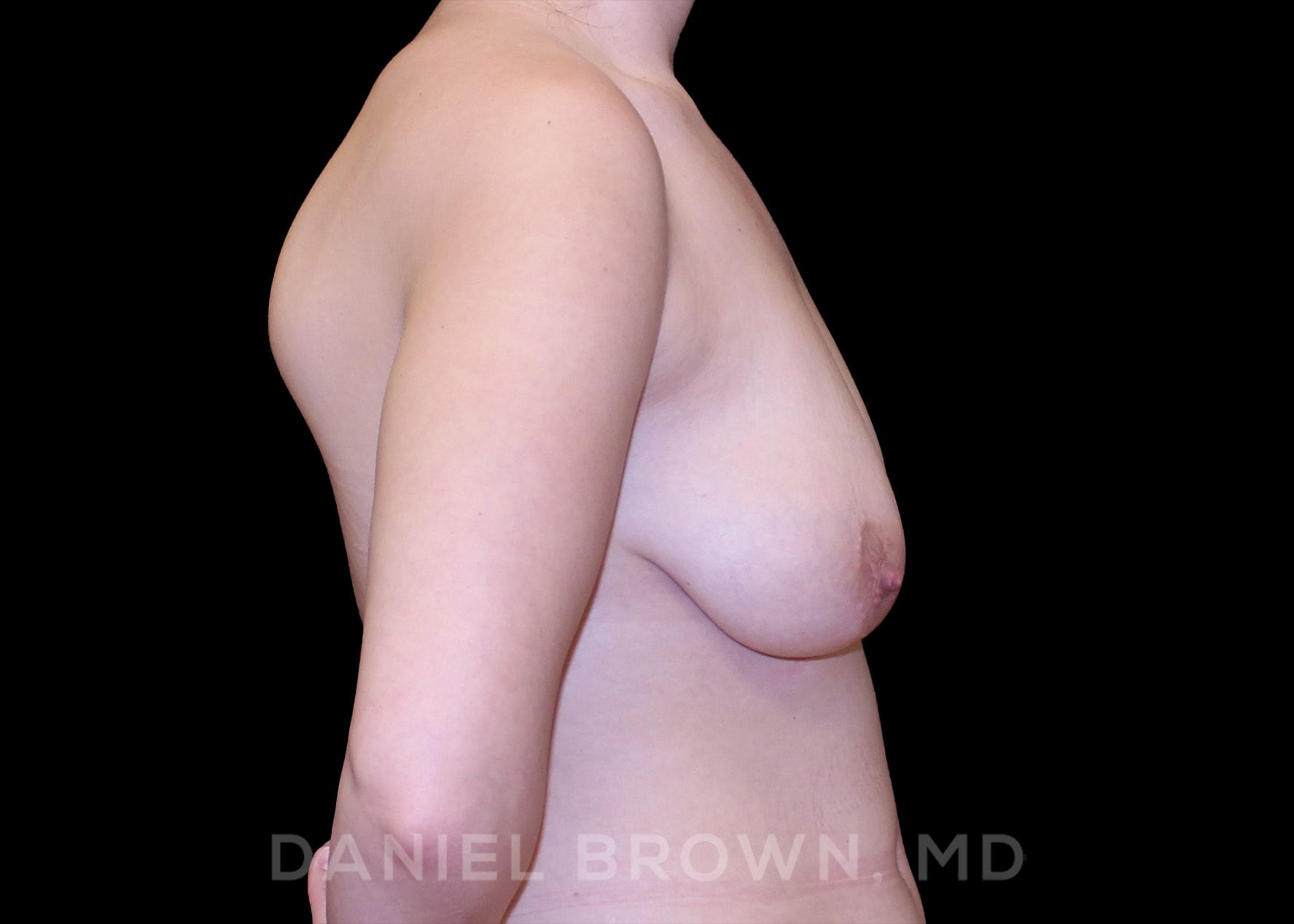 Bellesoma Breast Lift Patient Photo - Case 268 - before view-