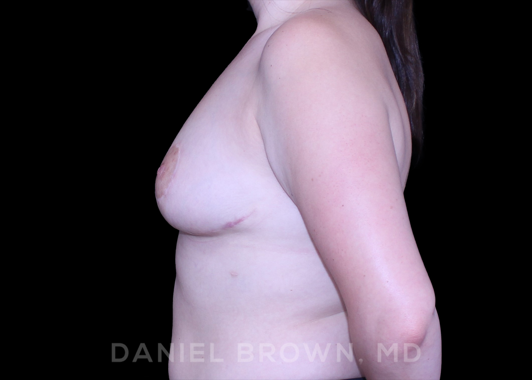 Bellesoma Breast Lift Patient Photo - Case 268 - after view-3