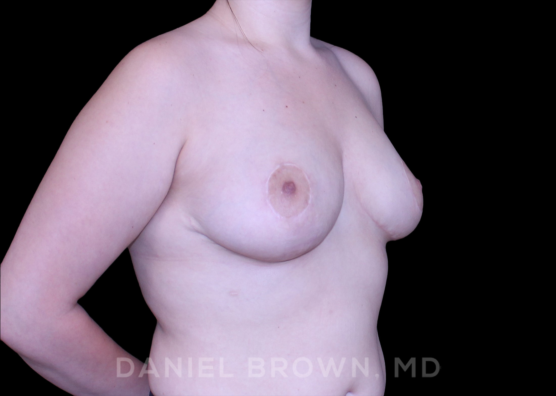 Bellesoma Breast Lift Patient Photo - Case 268 - after view