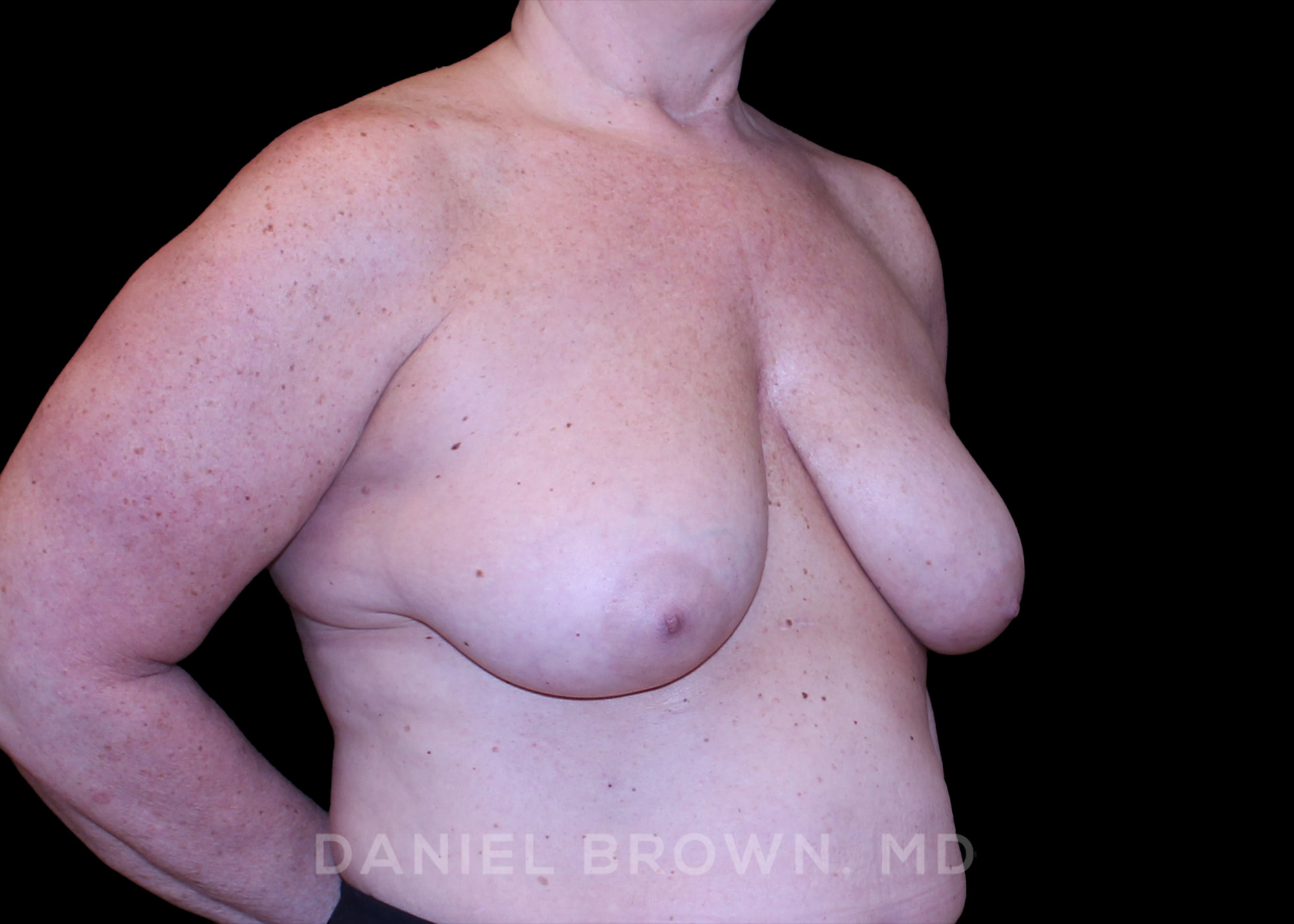 Bellesoma Breast Lift Patient Photo - Case 290 - before view-2