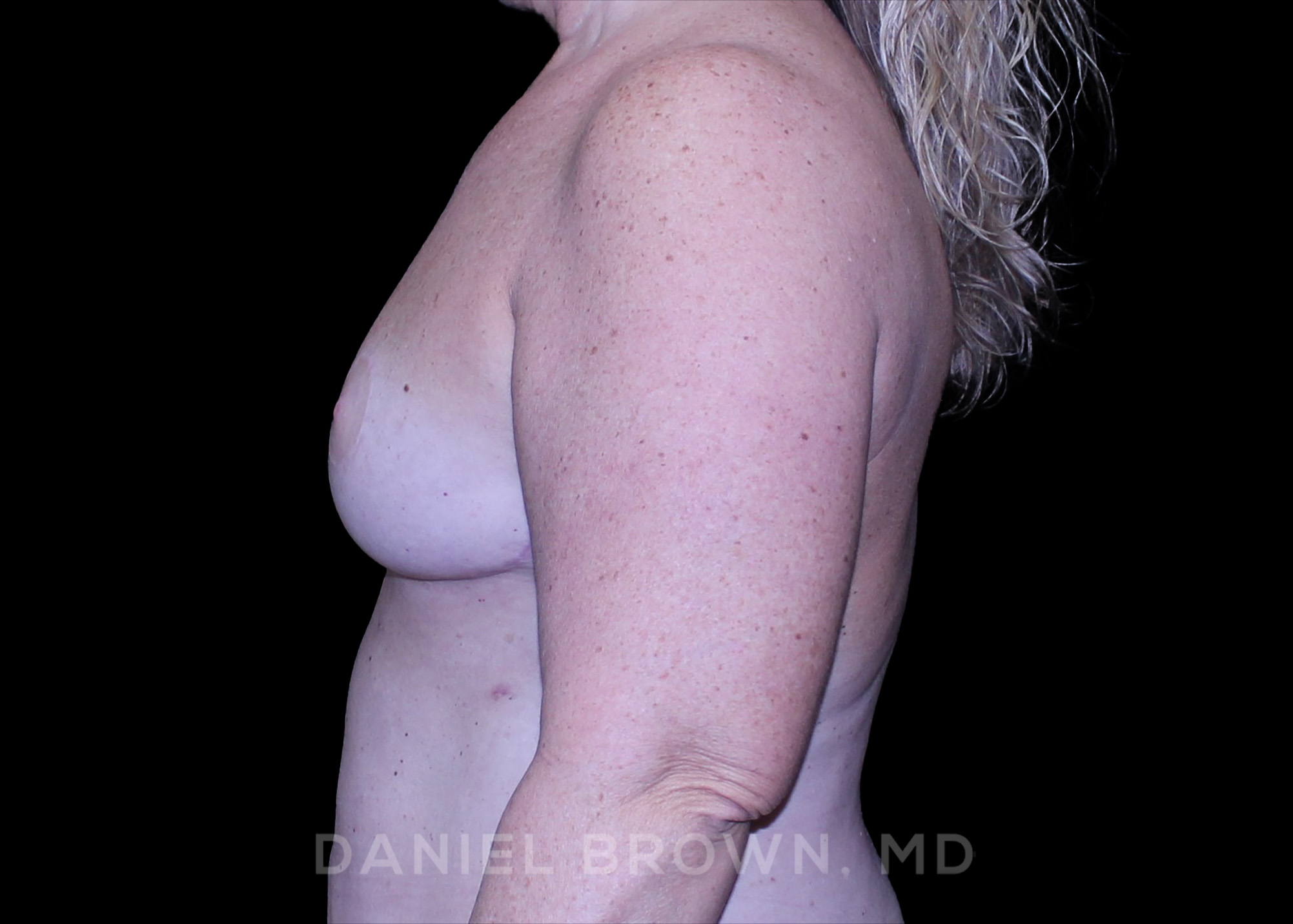 Bellesoma Breast Lift Patient Photo - Case 290 - after view-3