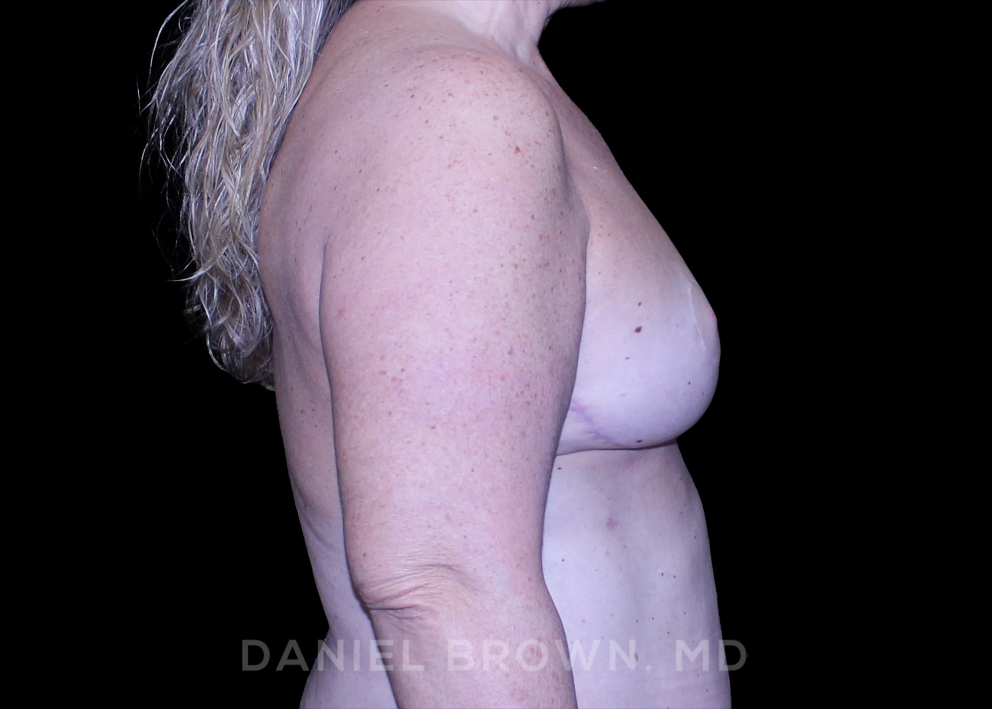 Bellesoma Breast Lift Patient Photo - Case 290 - after view