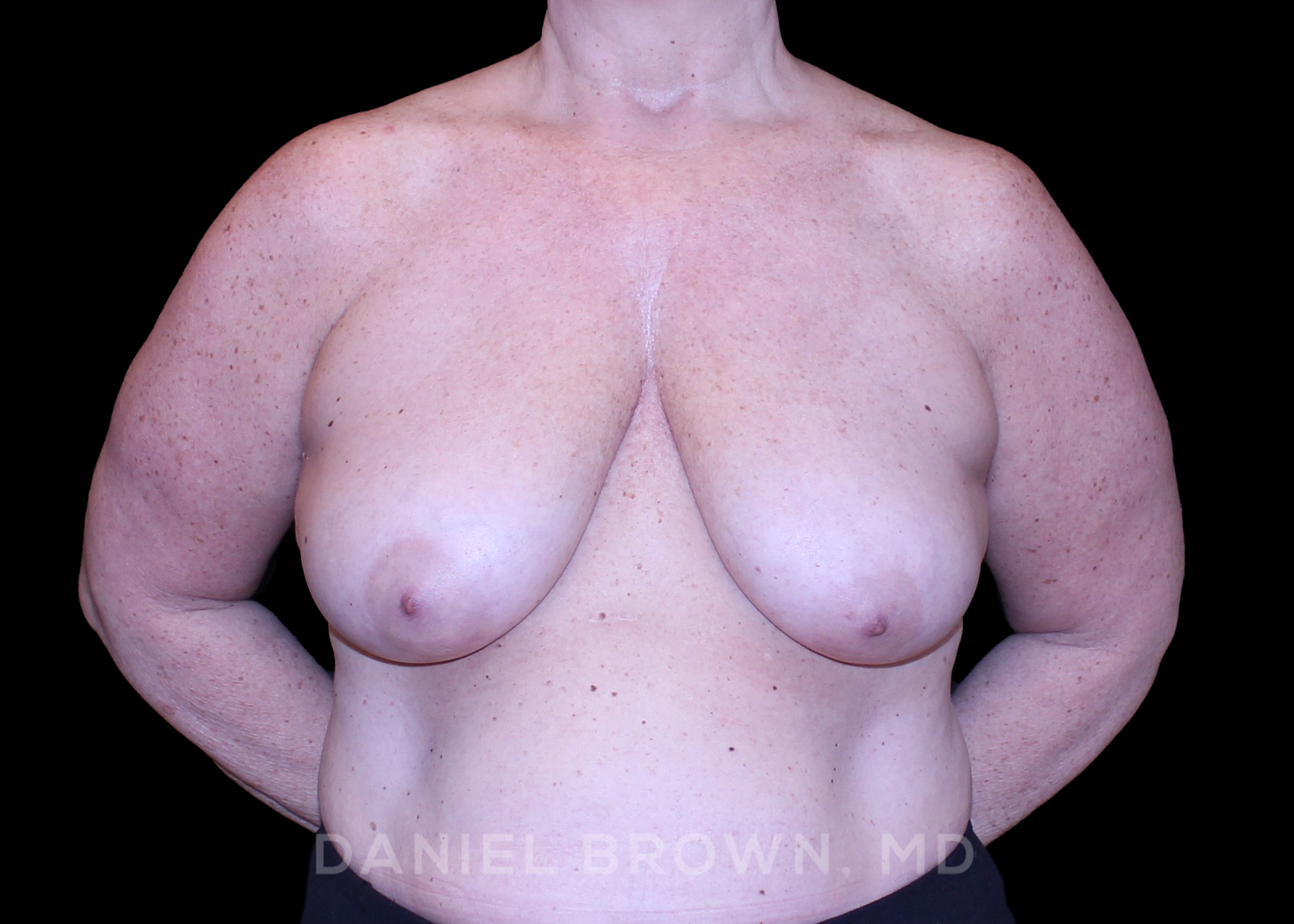 Bellesoma Breast Reduction, Daniel Brown M.D