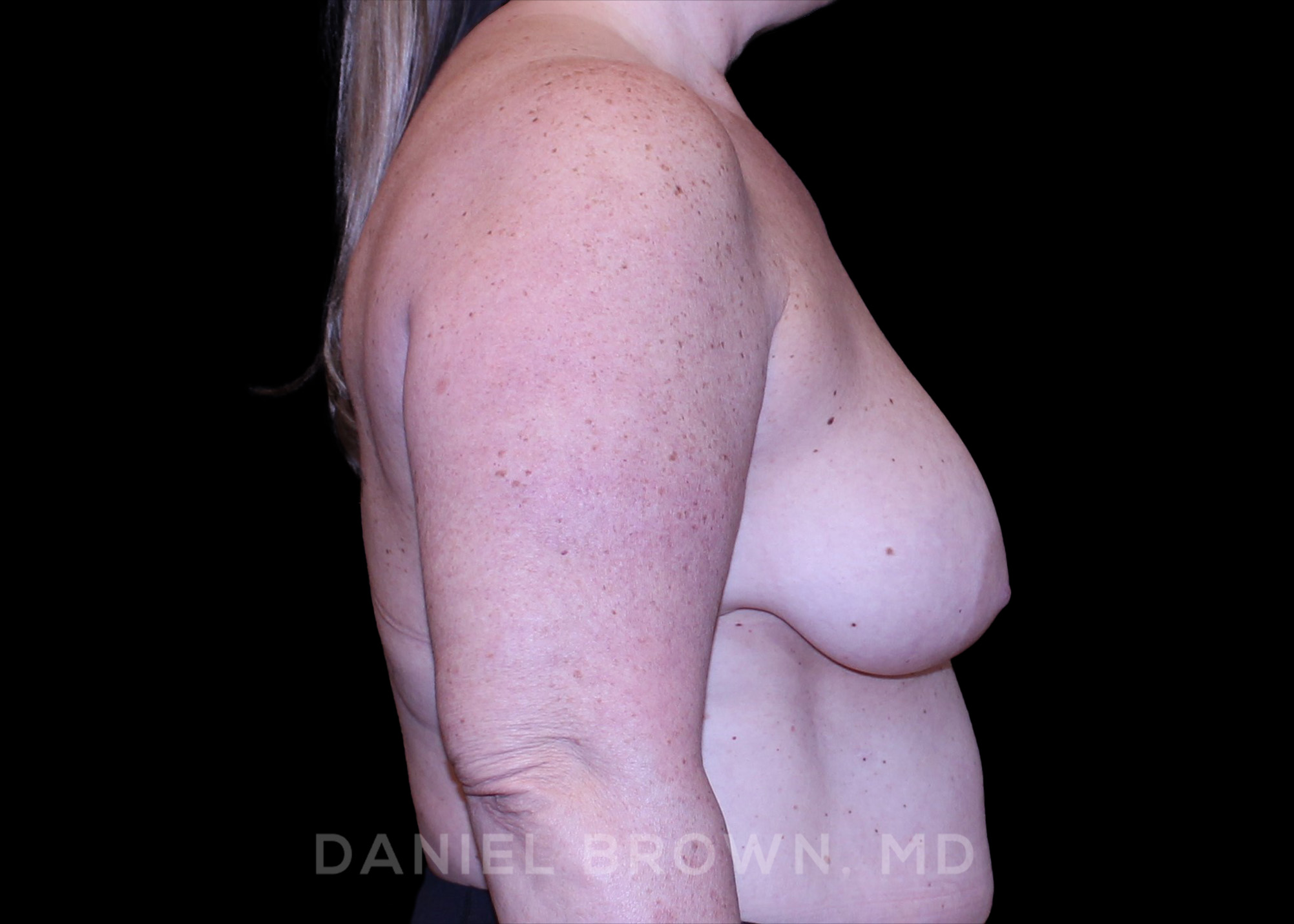 Bellesoma Breast Lift Patient Photo - Case 290 - before view-4