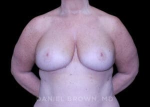 Bellesoma Breast Lift - Case 290 - After