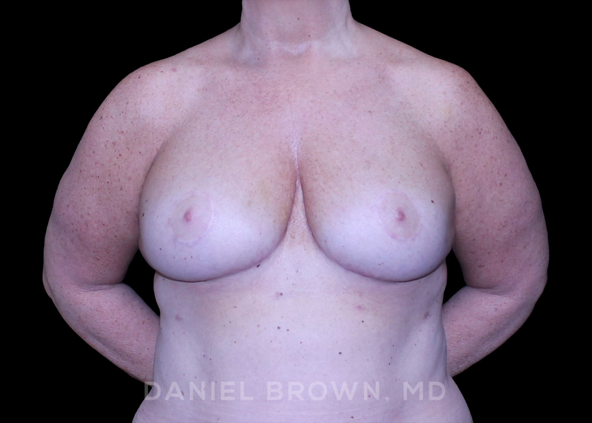 Bellesoma Breast Lift Patient Photo - Case 290 - after view-0