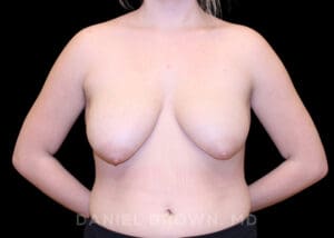Bellesoma Breast Lift - Case 301 - Before