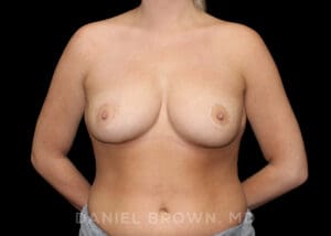 Bellesoma Breast Lift - Case 301 - After