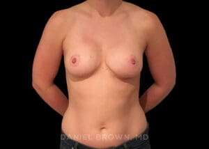 Bellesoma Breast Lift - Case 323 - After