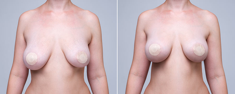 Bellesoma Breast Reduction, Daniel Brown M.D