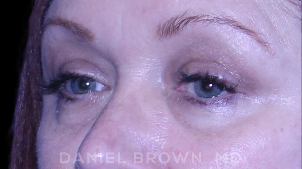 Blepharoplasty Patient Photo - Case 1000 - after view-2