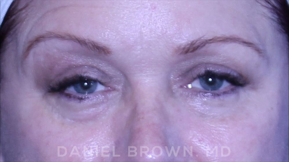 Blepharoplasty Patient Photo - Case 1000 - after view-1
