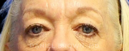 Blepharoplasty Patient Photo - Case 1021 - before view-