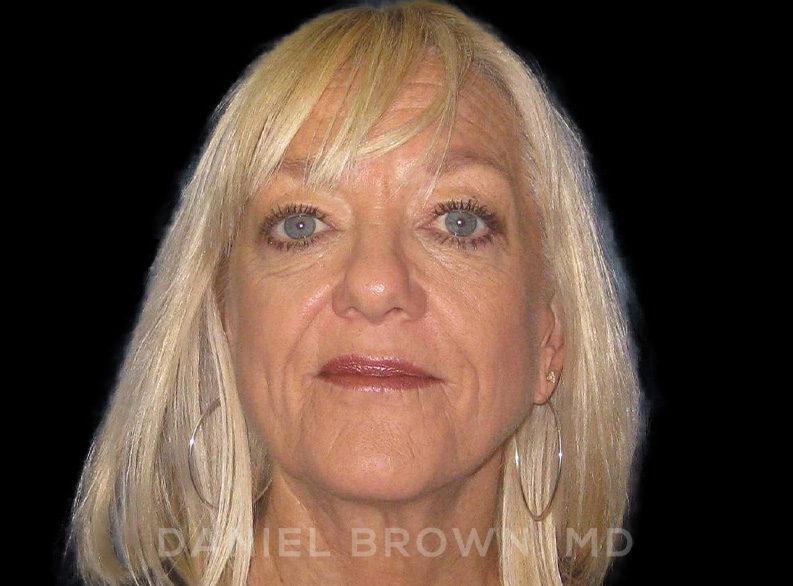 Blepharoplasty Patient Photo - Case 1021 - after view-0