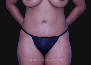 Tummy Tuck - Case 1053 - After