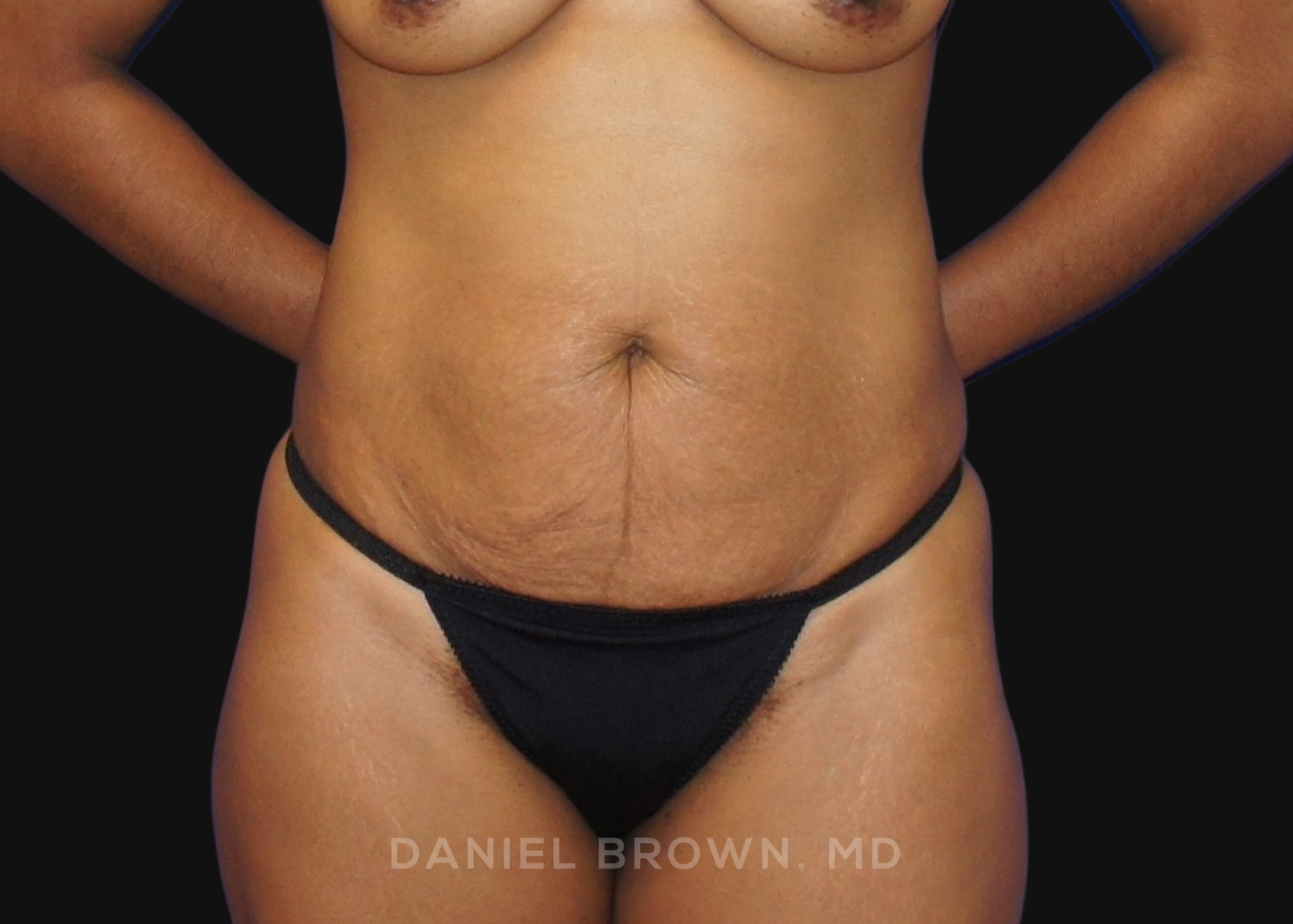 Tummy Tuck Patient Photo - Case 1053 - before view-0