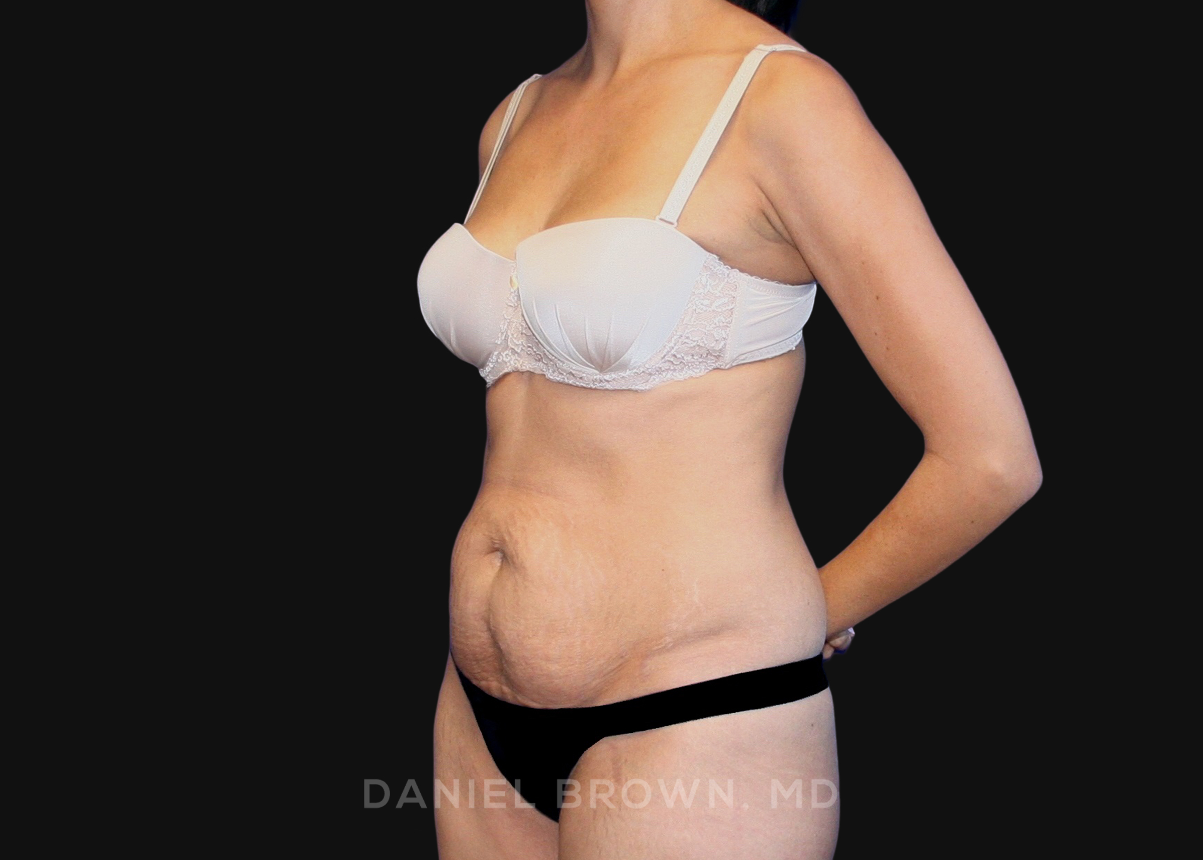 Tummy Tuck Patient Photo - Case 1090 - before view-1