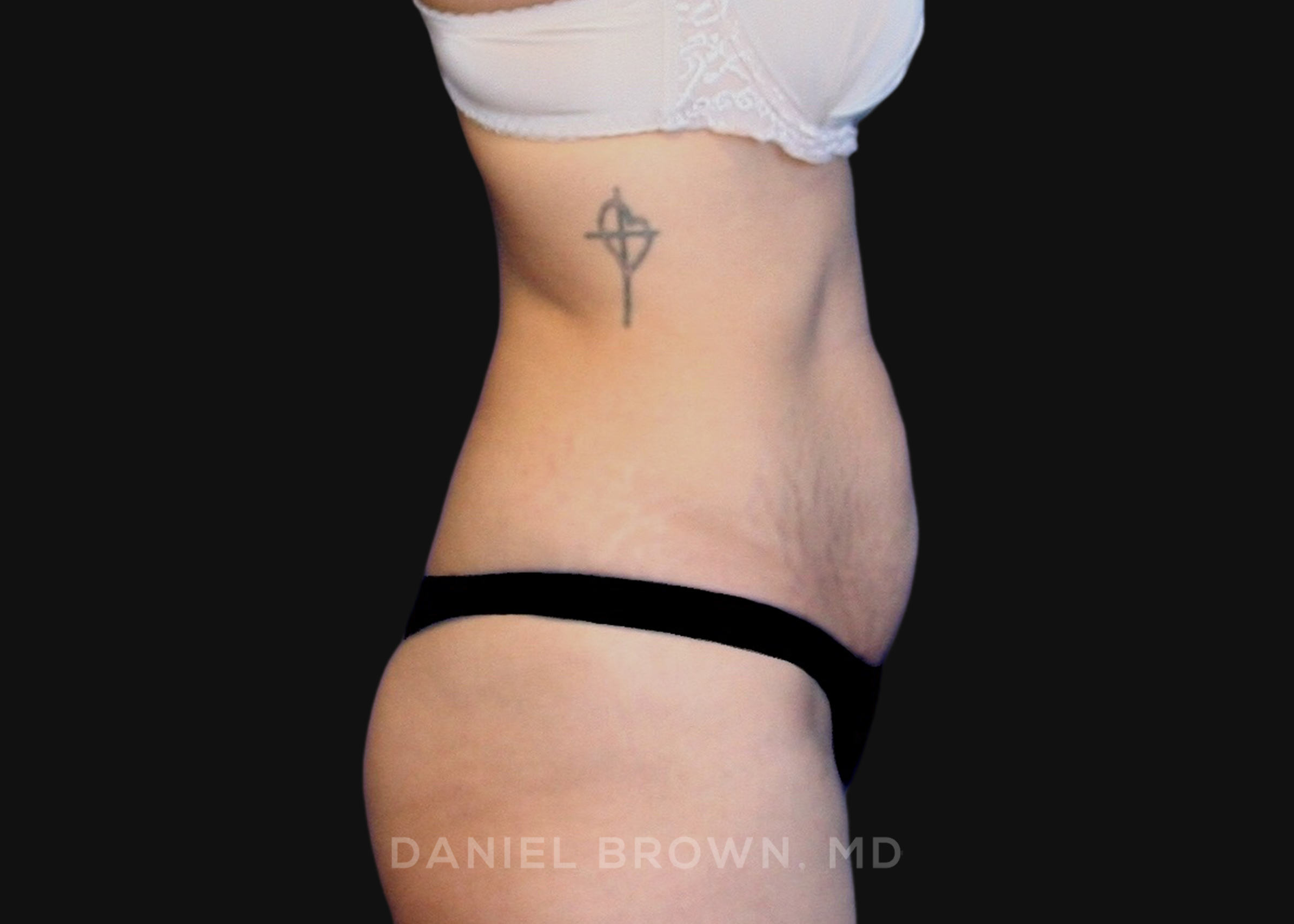 Tummy Tuck Patient Photo - Case 1090 - before view-