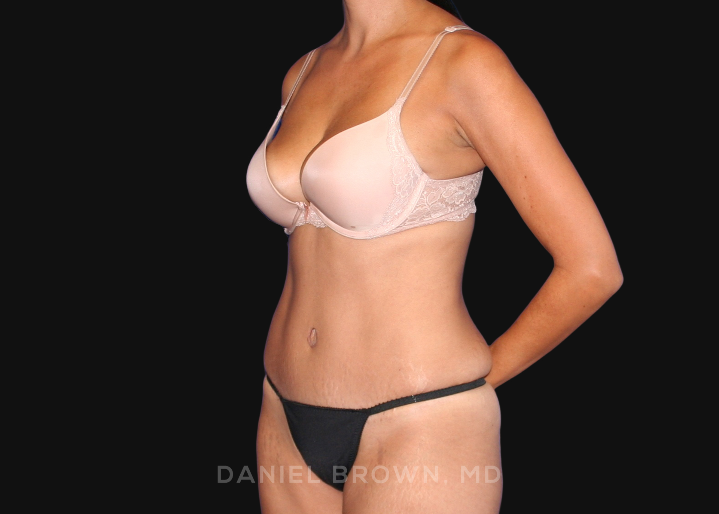 Tummy Tuck Patient Photo - Case 1090 - after view