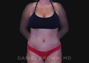 Tummy Tuck - Case 1101 - After