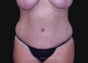 Tummy Tuck - Case 1125 - After