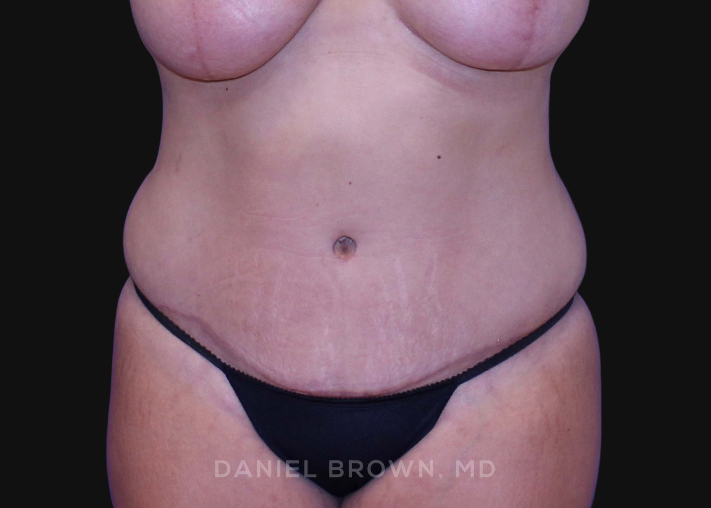 Tummy Tuck - Case 1125 - After