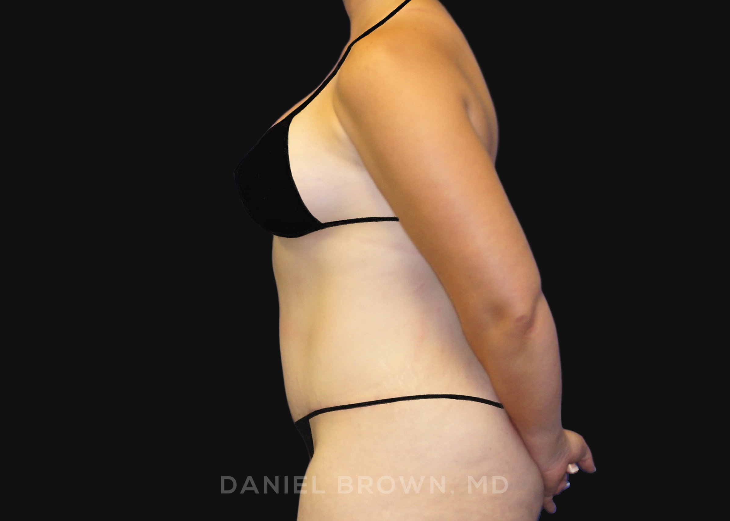 Tummy Tuck Patient Photo - Case 1156 - after view-2