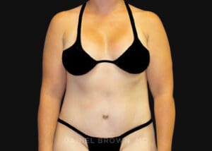 Tummy Tuck - Case 1156 - After